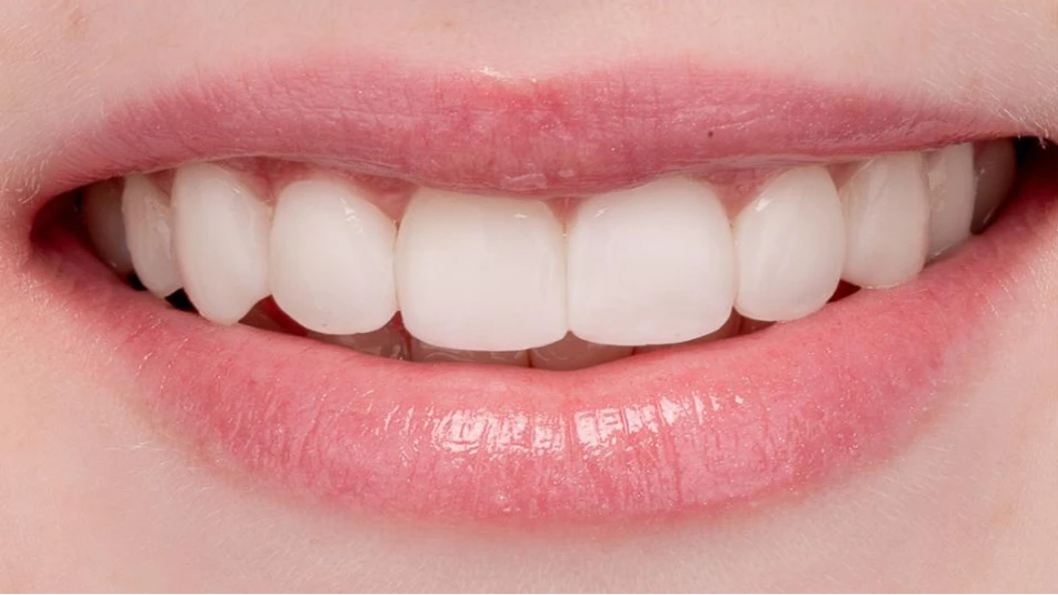 Closeup of veneers