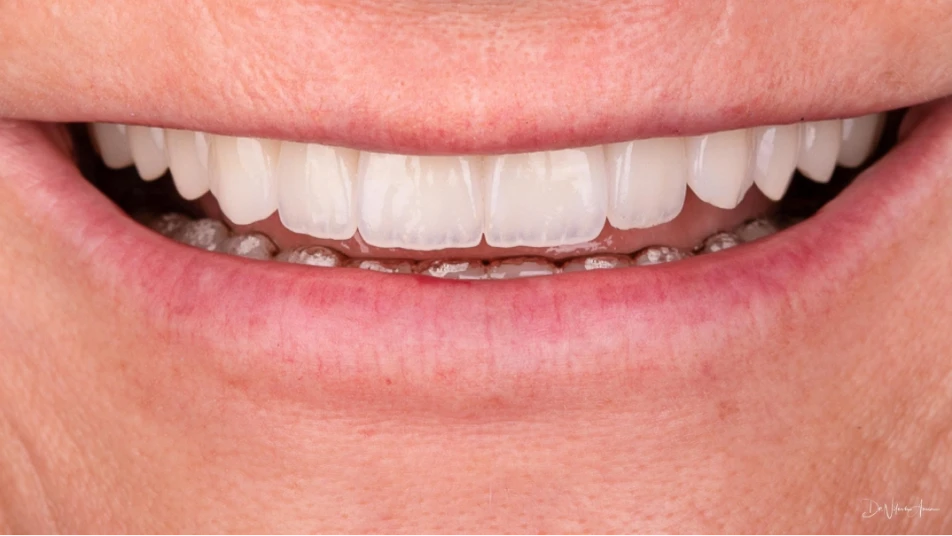 Closeup of veneers