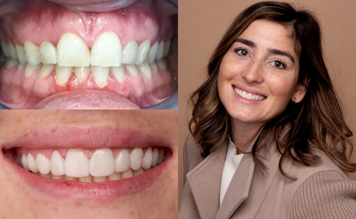 Floriane's teeth, before and after