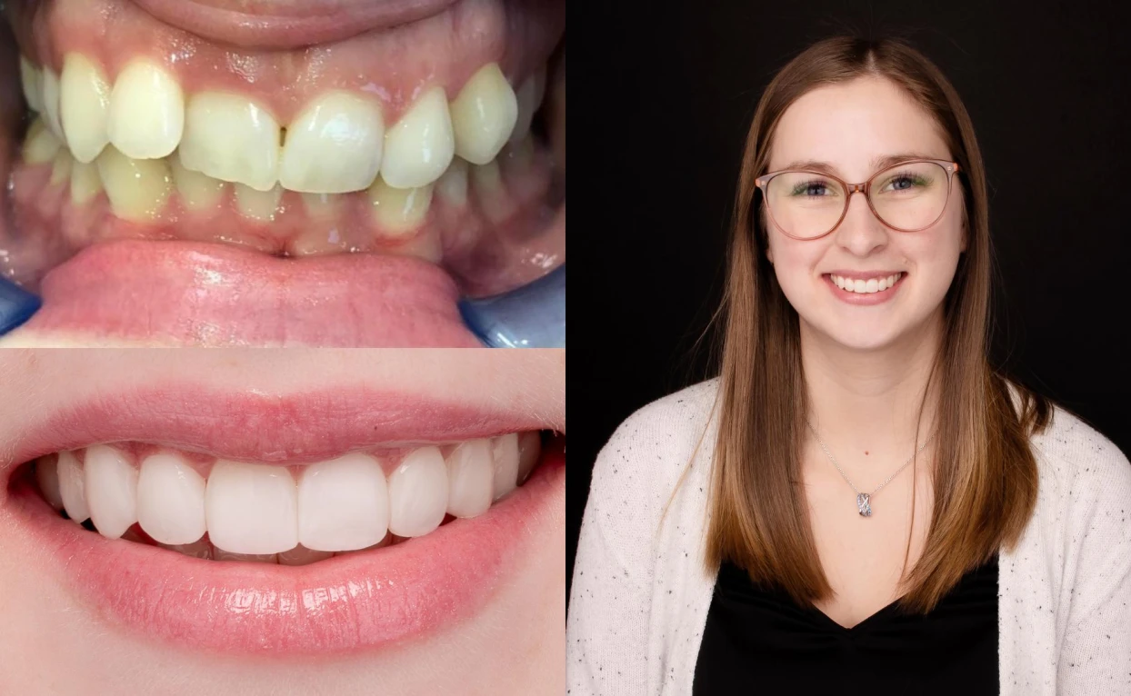 Rebecca's teeth, before and after
