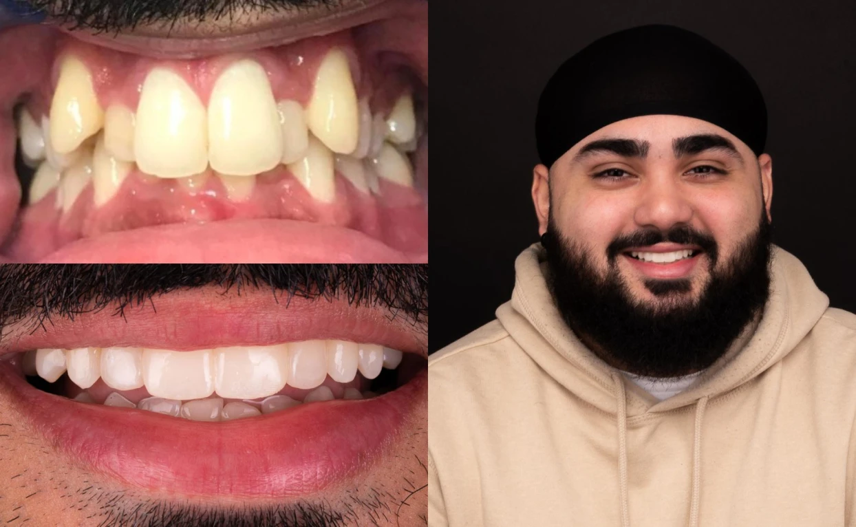 Gurpiar's teeth, before and after
