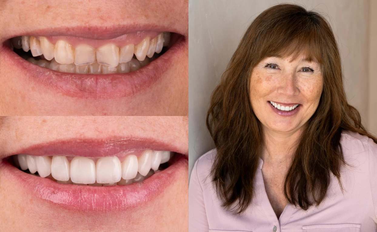 Katia's teeth, before and after