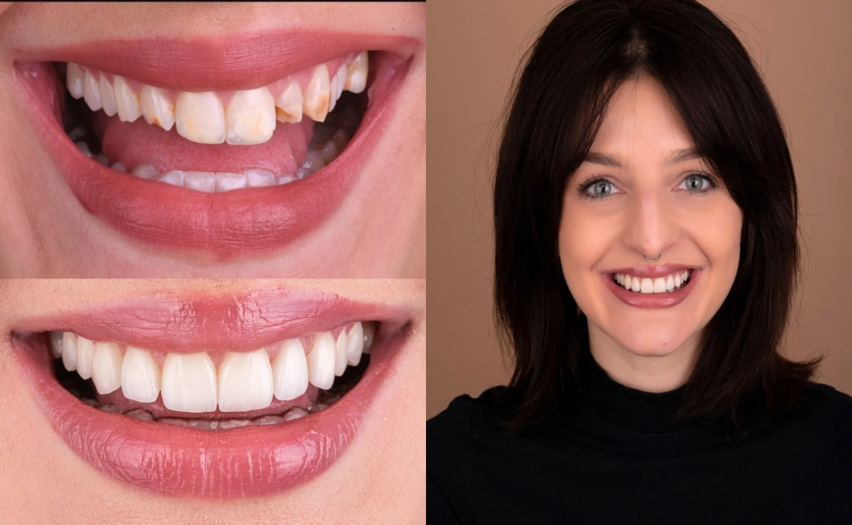 Victoria's teeth, before and after