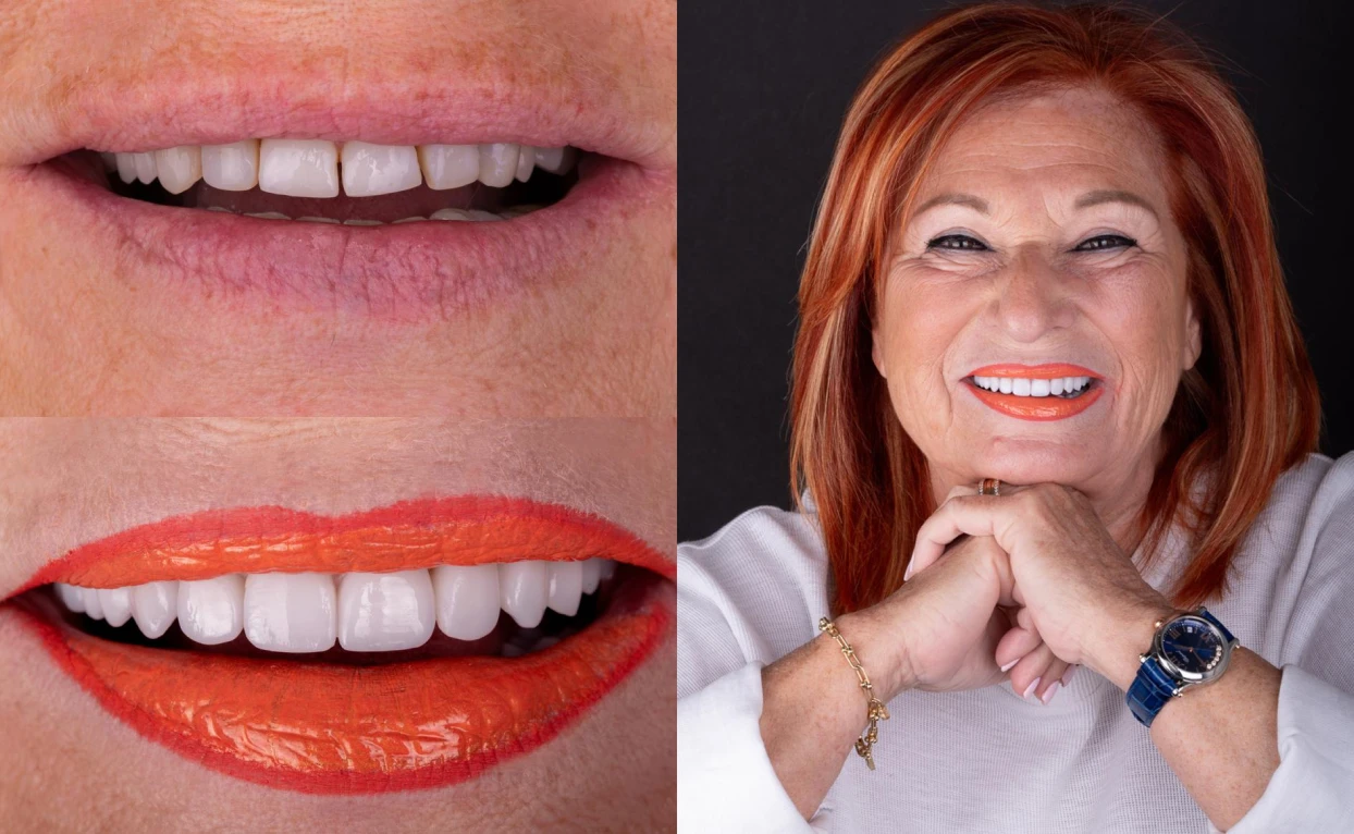 Irene's teeth, before and after