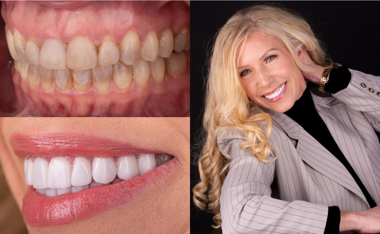 Mireille's teeth, before and after